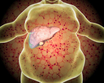 gan-nhiem-mo-nen-an-gi-thuc-don-khoa-hoc-giup-cai-thien-nhanh-chong